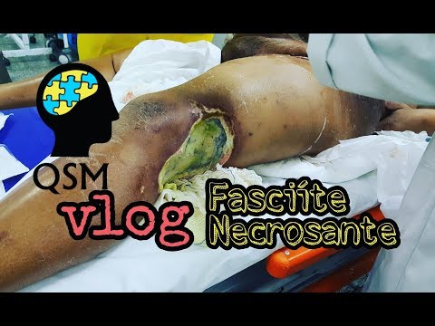 QSM VLOG | Fasciíte necrosante | Rotina no plantão de emergência e trauma