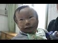 【難病】まるで仮面をつけたような顔。先天性面部横裂の赤ちゃん。