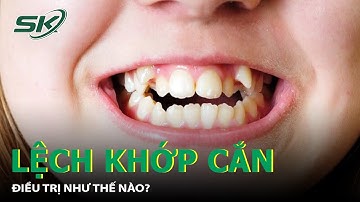 Lệch Khớp Cắn, Bệnh Phổ Biến Nhưng Tác Hại Khôn Lường