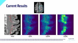 OCD - Automated Lesion Detection