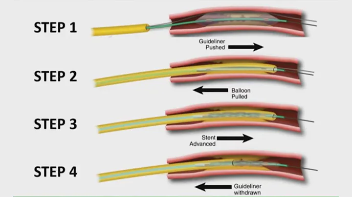 PCI of calcified left main – how to do it safely? PCR Round Table Webinar