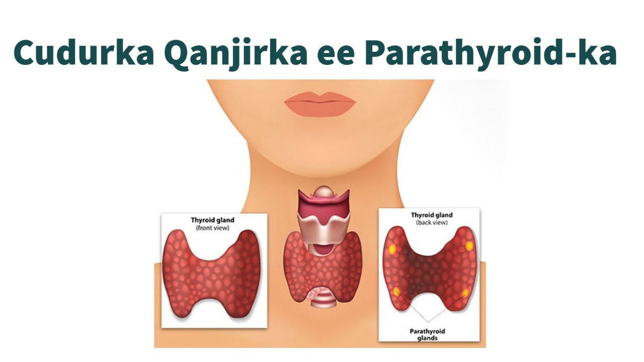 Part 2: Cudurka ku dhaca qanjirka ee Parathyroid-ka | Parathyroid Disease | Somali Bridge - WA