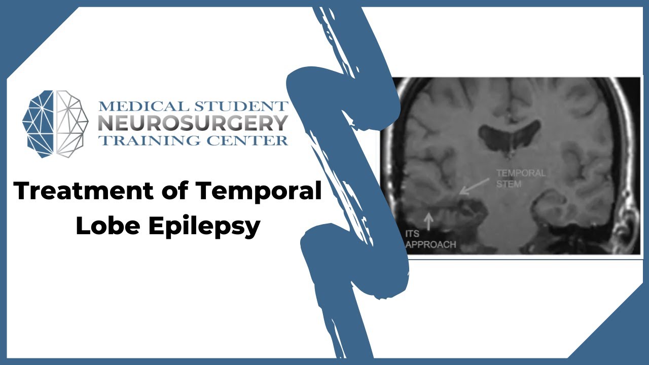 Treatment of Temporal Lobe Epilepsy - YouTube