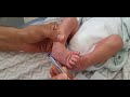 Pirani score  full explanation and evaluation  of a cublfoot in a 9 days old newborn