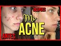 Mi experiencia con ROACCUTAN: Mes 1 |  Mi ACNE  | Juli Berea