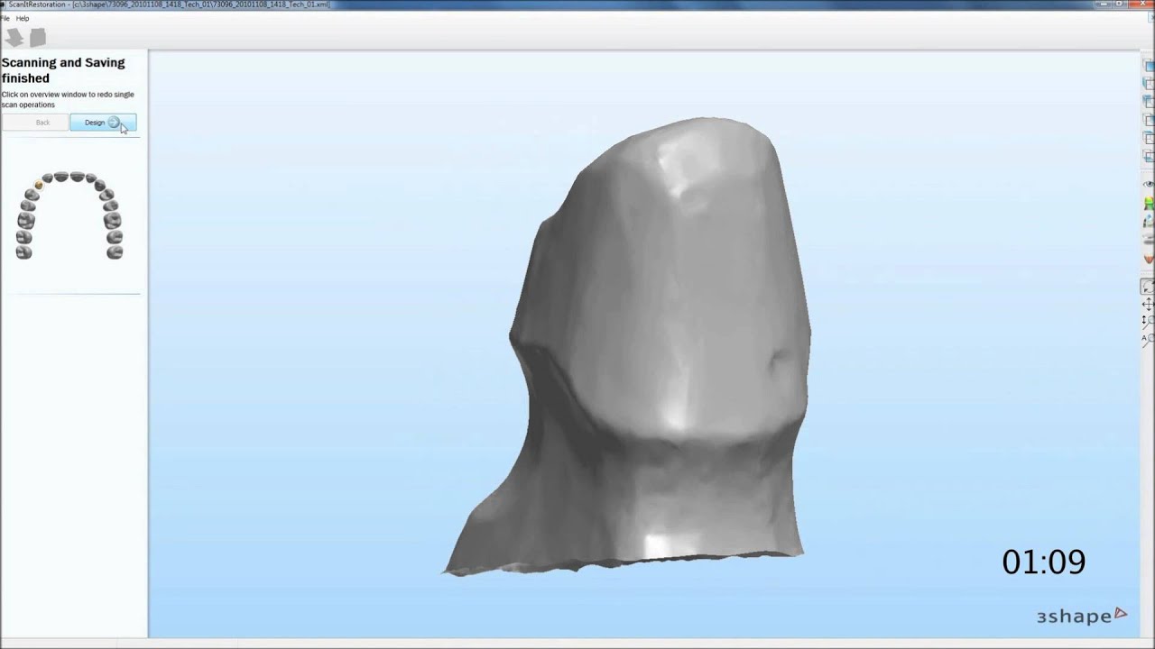 Käppchen in weniger als 2 min im 3shape DentalSystem - powered by WIELAND