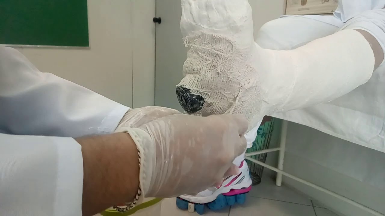 segunda parte, Aluno coloca o salto na bota gessada.