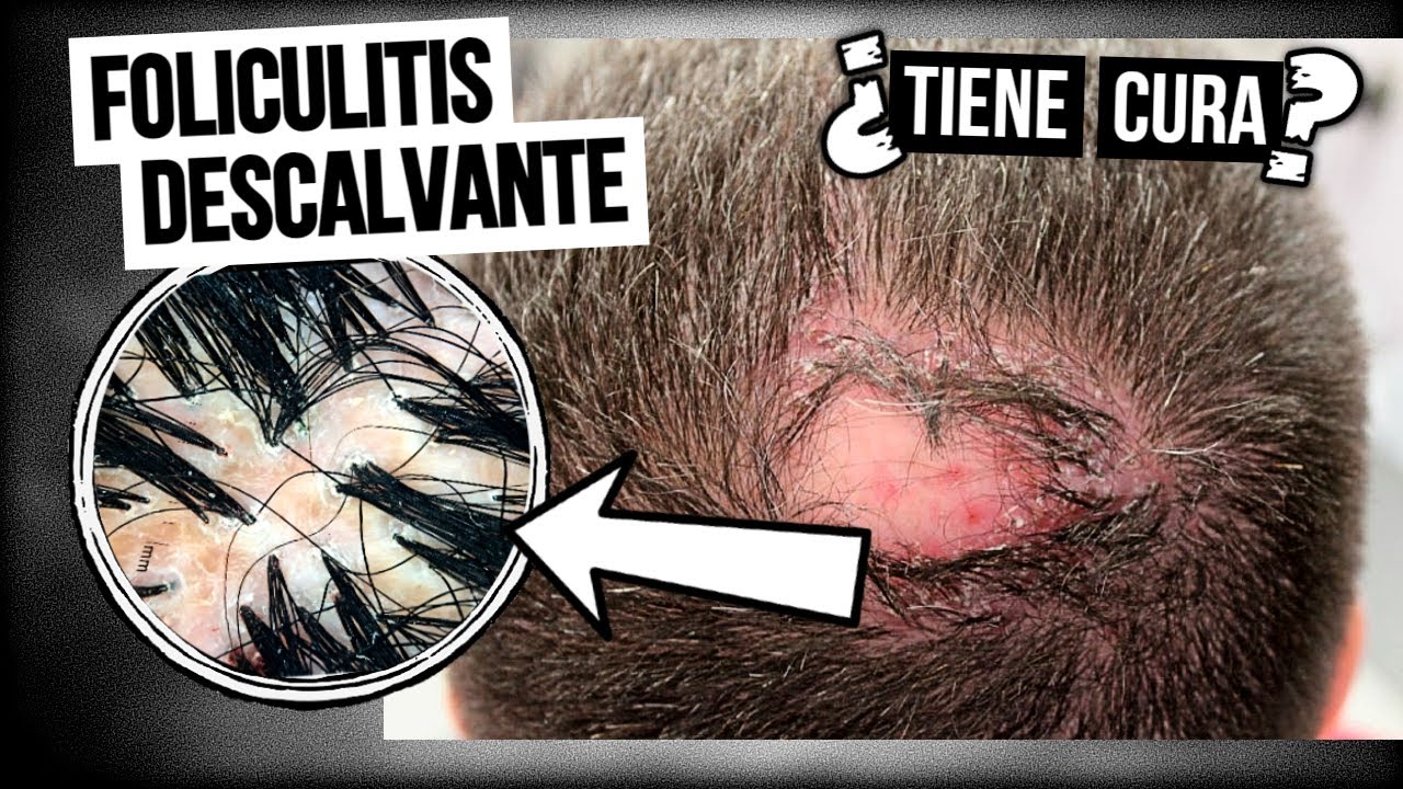 Acne en el cuero cabelludo