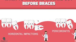 Should  Wisdom Teeth / Third Molars 3rd  be Removed before Braces?