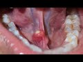 Whartons duct sialolith  removal under local anaesthesia  dr sunil kewat