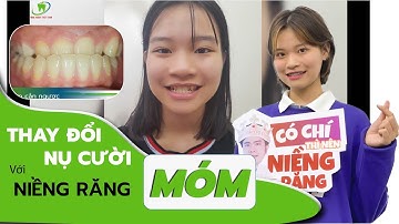 Niềng răng bao lâu thì hết khớp cắn ngược (móm)