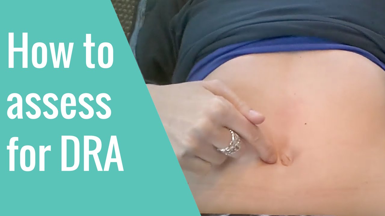 Taping for diastasis recti: criss cross method