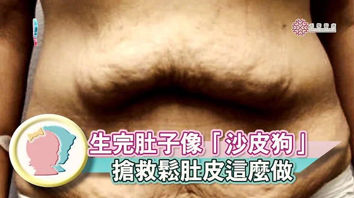 《生完肚子像「沙皮狗」  搶救鬆肚皮這麼做》【專家幫解答】《產後修護》│寶貝幫TV - 天天要聞