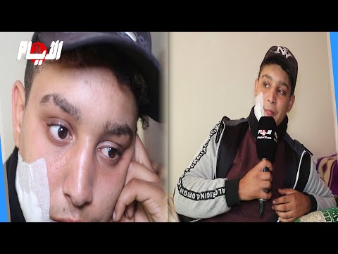 شو ه وجهه بسكي ن بسبب 150درهم شاب يتعرض لمحا ولة التصفية من قبل صديقه جا من ورايا وغد رني