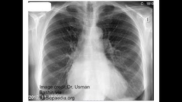 Congestive Heart Failure (Part 2)