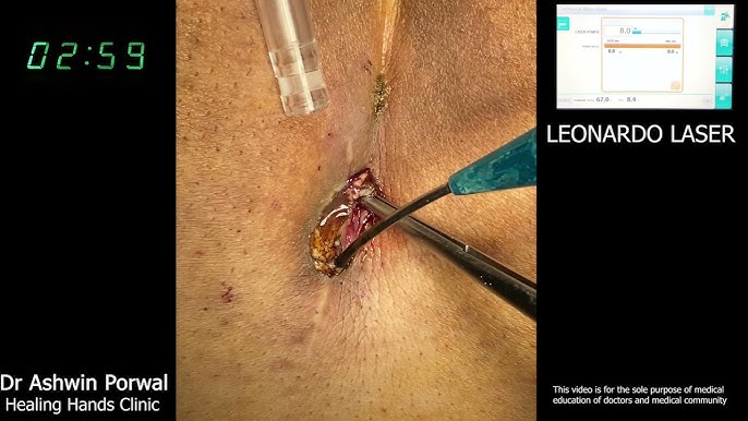 Pilonidal Cyst Cure by Laser has replaced surgery - Laven Clinic