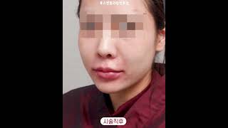 입술필러 입꼬리필러 같이 하면 이렇게 바뀐다고?