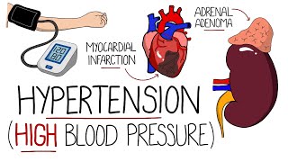 Hypertension Explained (High Blood Pressure)  Includes Hypertensive Emergency & NICE Guidelines