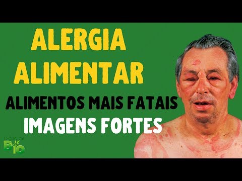 ALERGIA ALIMENTAR: ALIMENTOS QUE MATAM por reação alérgica