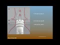 Polymer Approaches to EVAR: Ovation Stent Graft and Nellix Endobags - Steve Henao, MD