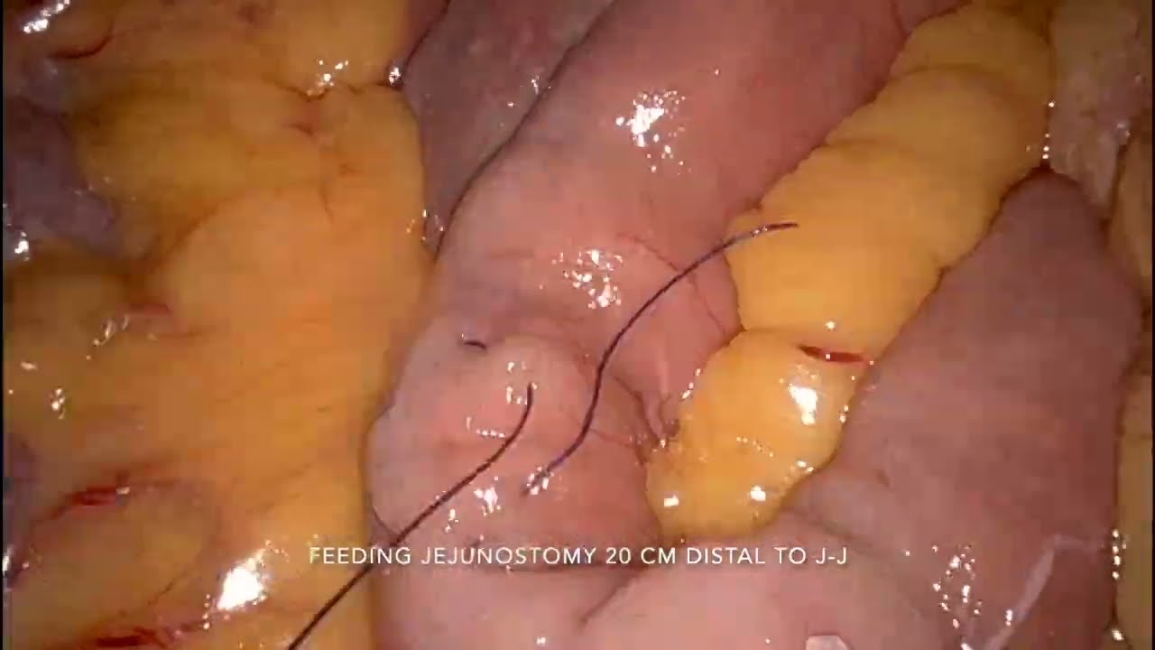 Master video presentation: Robotic assisted total gastrectomy with D2 LN dissection ISO-2025 Jaipur