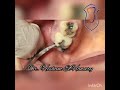 flapless surgical extraction of RR of upper right third molar using Cryer