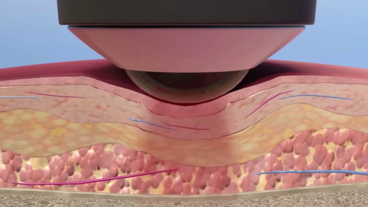 Pure Chiropractic Center Cold Laser Therapy