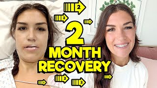 Double Jaw Surgery (2 Months Post Op!) What I Wish I Knew Before... Ep. 8