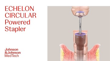 How to Use ECHELON CIRCULAR Powered Stapler | J&J MedTech