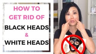 Tips on How to Remove Blackheads and Whiteheads