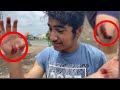 HAD TO RUSH TO THE HOSPITAL! • Bad Injury