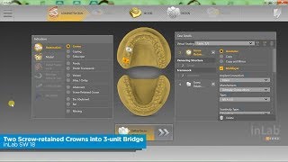 inLab SW 18: How to Convert a Sirona Connect Case That Contains Two Screw retained Crowns into a 3 U