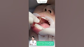 Niềng răng trong suốt Smartalign tại Tracydentist có gì đặc biệt?