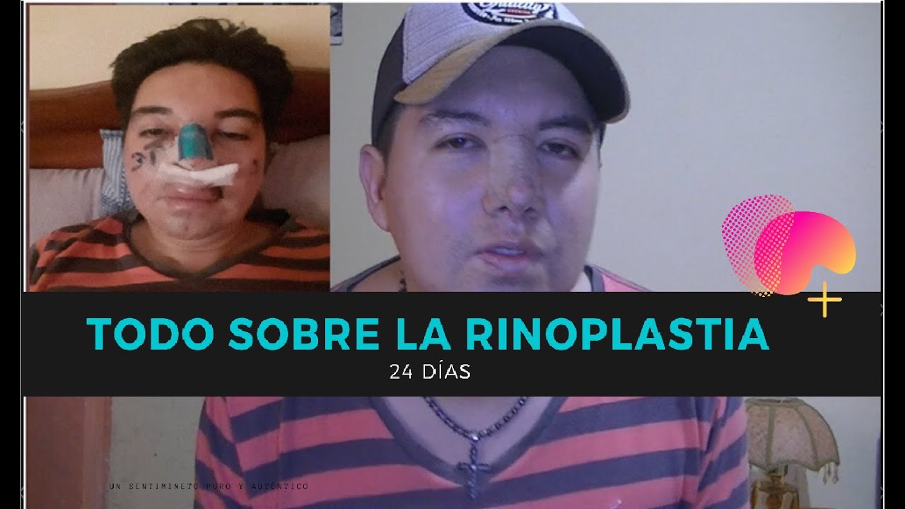 Cuanto Cuesta Una Rinoplastia En Ecuador Youtube