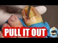 YOU HAVE AN INGROWN TOENAIL...NOW LET’S GET IT OUT!!! ***PART 2***