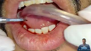 إزالة جير الأسنان|علاج نزيف اللثه| dental plaque removal |دكتور_عبدالله_سلطان_الهنداوي_طبيب_اسنان
