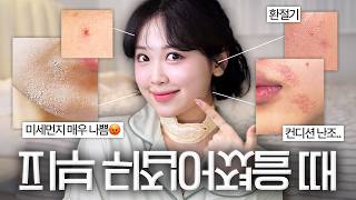 딱 3일🔥 뒤집어진 피부 복구 기적의 루틴✨ 화장품 개발자가 연구한 짱쉬운 루틴 공개! 100번 넘게 이 방법으로 되살렸습니다 (셀프 인체실험 완료🧪)