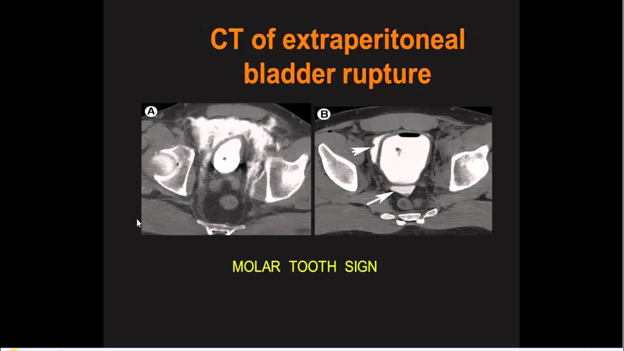 7IMAGING ABDOMEN TRAUMA URINARY BLADDER TRAUMA PART 7 Dr AHMED ESAWY