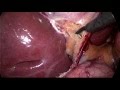 Lap chole simple mpeg4dr jitendra mistrybaroda laparoscopy hospital