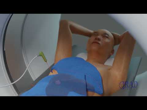 Liver Tumor Ablation CT Guided Microwave Ablation