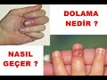 Dolamaya (Tırnak Dibi İltihabına) Ne İyi Gelir... İşte  Doğal Çözümler...