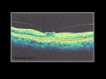 Vitreous 2: Vitreous and Trouble