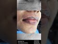 Lip Blushing Before and After | Dark Lip Correction | Lip Blushing Treatment