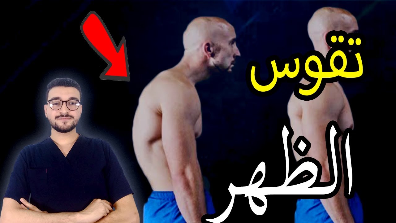 تقوس الظهر | الأتب | تحدب العمود الفقري - YouTube