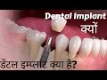 What Dental Implant? डेंटल इम्प्लांट क्या है? जरूरत, क्या साइड इफेक्ट्स और समस्याएं, प्रक्रिया क्या