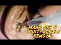 Man's Dry & Crusty Earwax Causing Ringing of Ears is Finally Removed