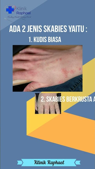 Apa itu skabies atau kudis?