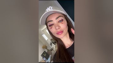 Upper & Lower Eyelid Surgery (Blepharoplasty) #cosmeticsurgery #eyelid #aesthatic #surgery #signatur