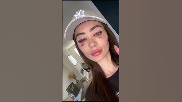 Upper & Lower Eyelid Surgery (Blepharoplasty) #cosmeticsurgery #eyelid #aesthatic #surgery #signatur