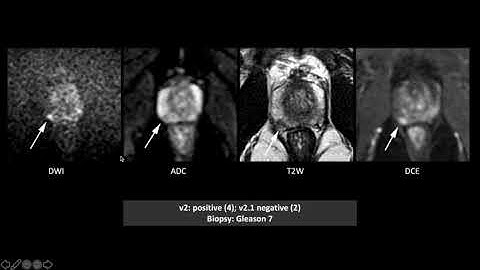 PI-RADS v2 and 2.1: Interobserver Agreement & Diagnostic Performance in Peripheral & Transition Zone